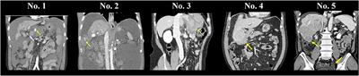 Outcomes of Living Donor Liver Transplantation in Patients With a History of Ruptured Hepatocellular Carcinoma